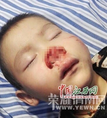 ������ͯ�Ǽⱻ��ҧ�� ��ȱǮ������ҩˮ������